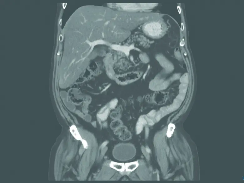 Chest Abdo Pelvis CT 0001