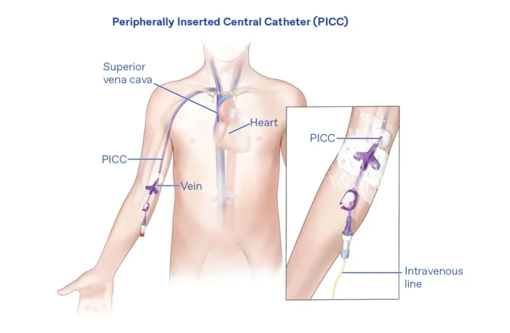 PICC Line Insertion